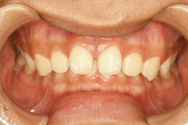 左右側の中切歯、側切歯の計4カ所に対するダイレクトボンディング