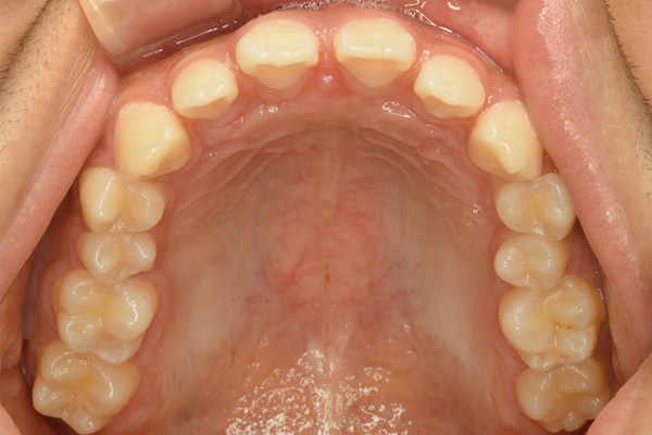 左右側の中切歯、側切歯の計4カ所に対するダイレクトボンディング