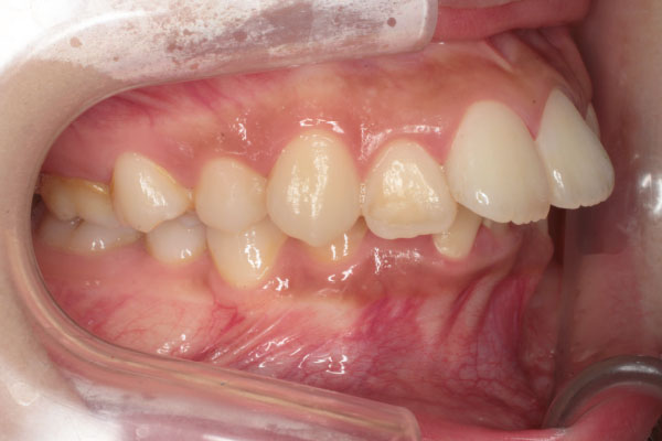 上顎左右側第一小臼歯抜歯を行い裏側(舌側)矯正
