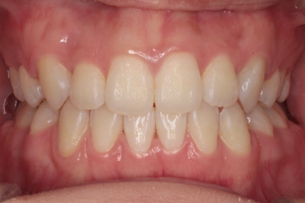 左右側上下顎第一小臼歯を計４本抜歯を行い裏側(舌側)矯正