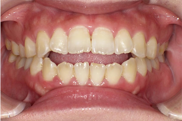 上下顎左右側第一小臼歯抜歯を行いマウスピース矯正